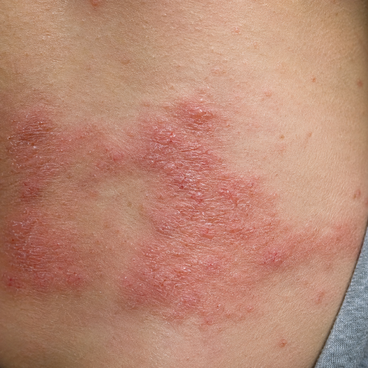 What is Eczema?